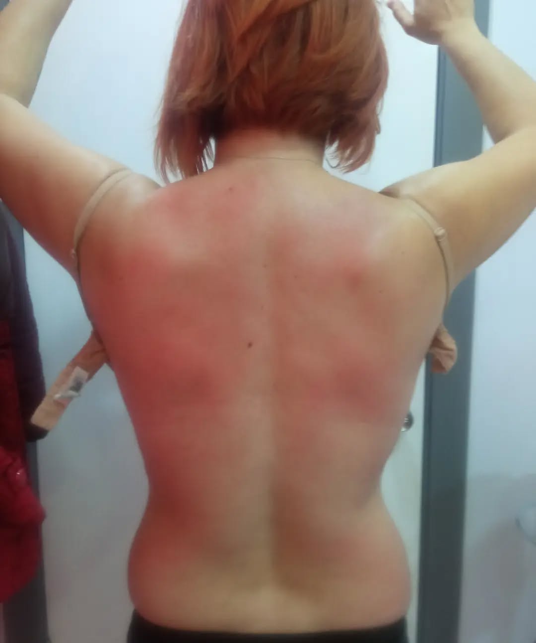 Skolyoz Düzeltme Masajı